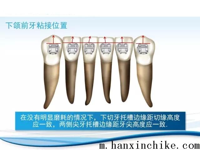正畸托槽粘接位置