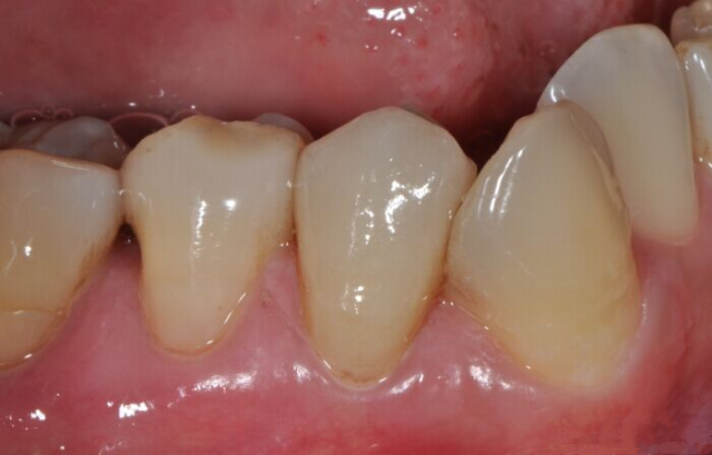 近期树脂修复案